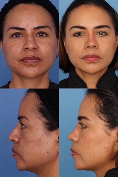 Dorsal Hump Before & After Gallery - Patient Bj3HQiXRTsiMyIQOy-TmaA - Image 1