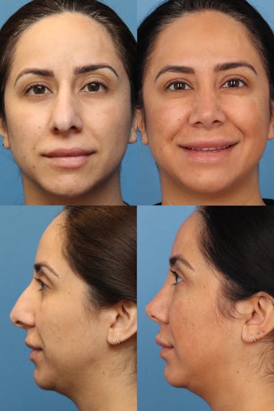 Prominent Nostril / Hanging Columella Before & After Gallery - Patient 419315 - Image 1
