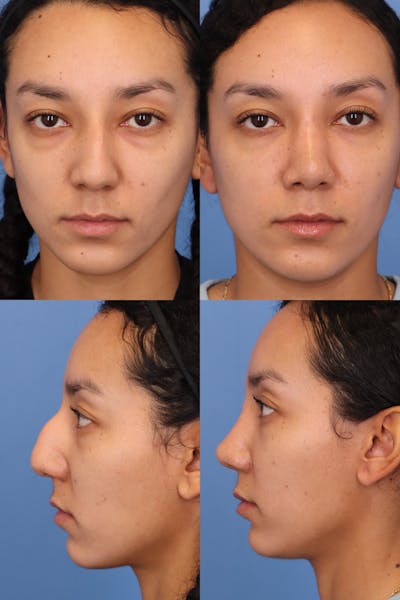 Dorsal Hump Before & After Gallery - Patient II-yz0YsSzaKcTd5cb4H3g - Image 1