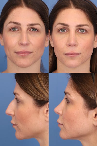Dorsal Hump Before & After Gallery - Patient dyg11z_JQP2LBaxAjKYrow - Image 1