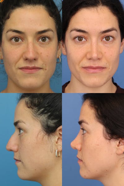 Dorsal Hump Before & After Gallery - Patient ZdTX8PyFR5CCunSOUld4Vw - Image 1
