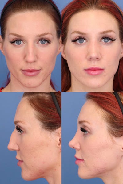 Dorsal Hump Before & After Gallery - Patient NSO2tIdcTKeg05gwzCWUwQ - Image 1