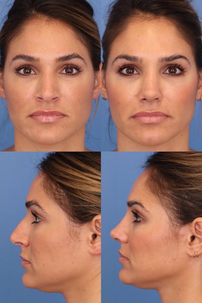 Dorsal Hump Before & After Gallery - Patient dvoYaNIvSbeY0rklZNnqug - Image 1