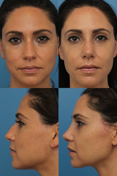 Dorsal Hump Before & After Gallery - Patient PU3MYTY_StqxeqOWGOKLLg - Image 1