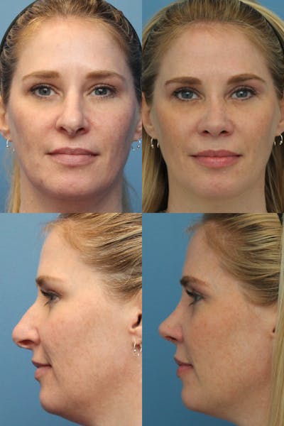 Prominent Nostril / Hanging Columella Before & After Gallery - Patient 281883 - Image 1