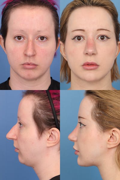 Over Projecting Tip Before & After Gallery - Patient EwvwcmT8Qy6a4iW47X80dg - Image 1