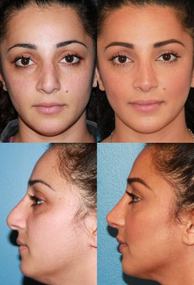 Prominent Nostril / Hanging Columella Before & After Gallery - Patient 176895 - Image 1