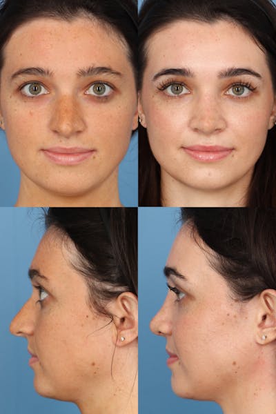 Over Projecting Tip Before & After Gallery - Patient L6UDD1EESnKmzm4o6Av-ZA - Image 1