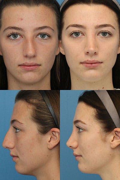 Dorsal Hump Before & After Gallery - Patient YAoS-EocROqWBuX78YWIMA - Image 1