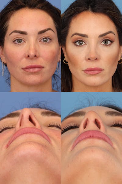 Crooked Nose Before & After Gallery - Patient HccivKZ7SJWWfpZgQIaAlw - Image 1