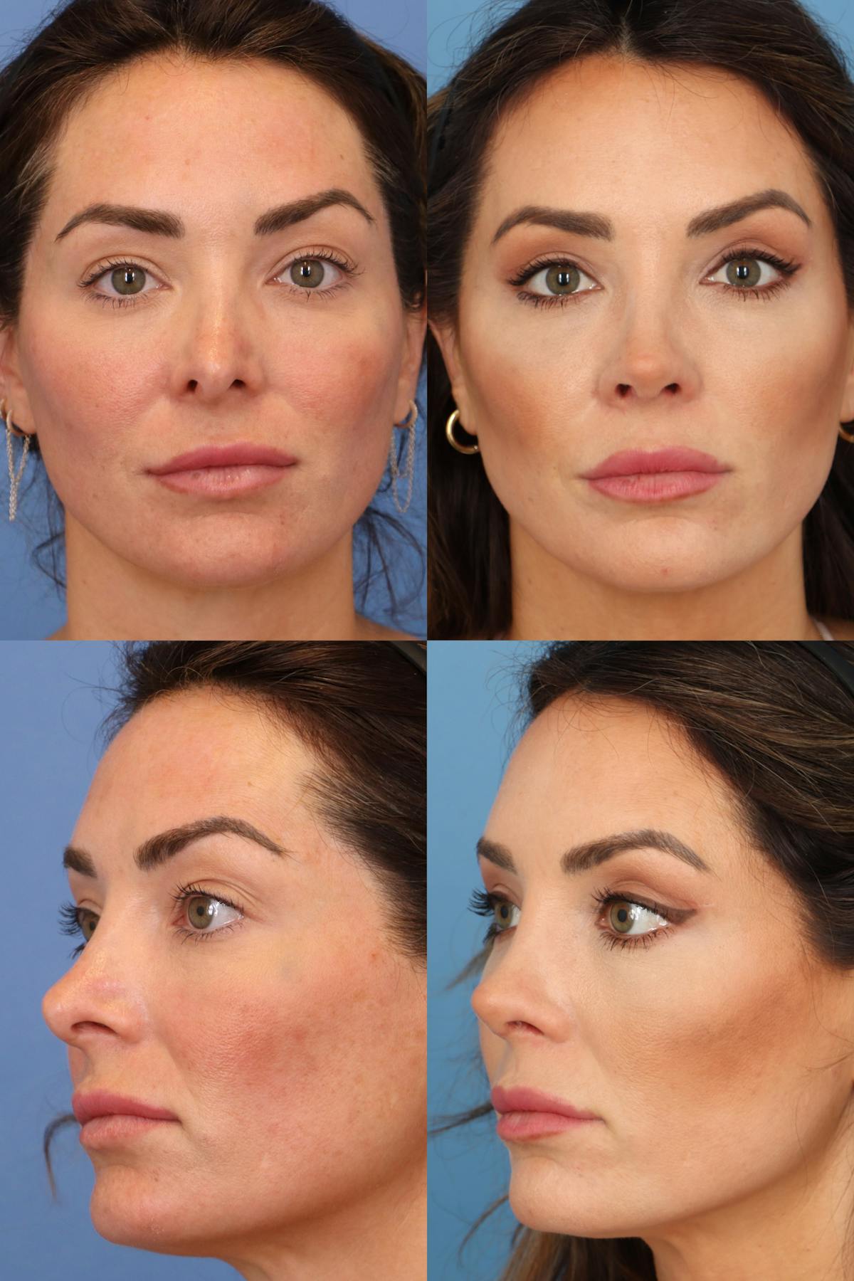 Female Revision Rhinoplasty Before & After Gallery - Patient 382052 - Image 1