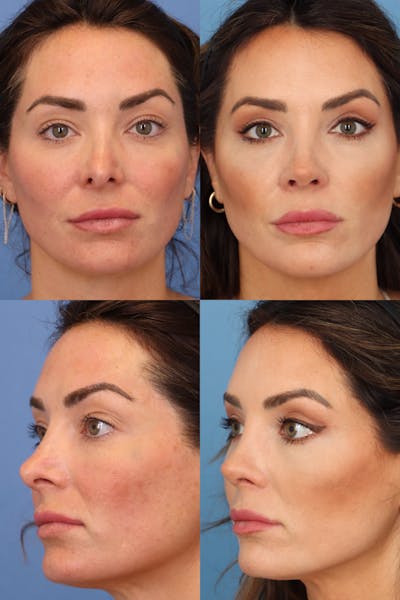 Crooked Nose Before & After Gallery - Patient Vgk23PWmQoiEXQmifoMX3Q - Image 1
