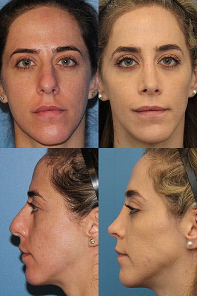 Dorsal Hump Before & After Gallery - Patient ZAcefNpYQRO3Y_kB2eoj-g - Image 1