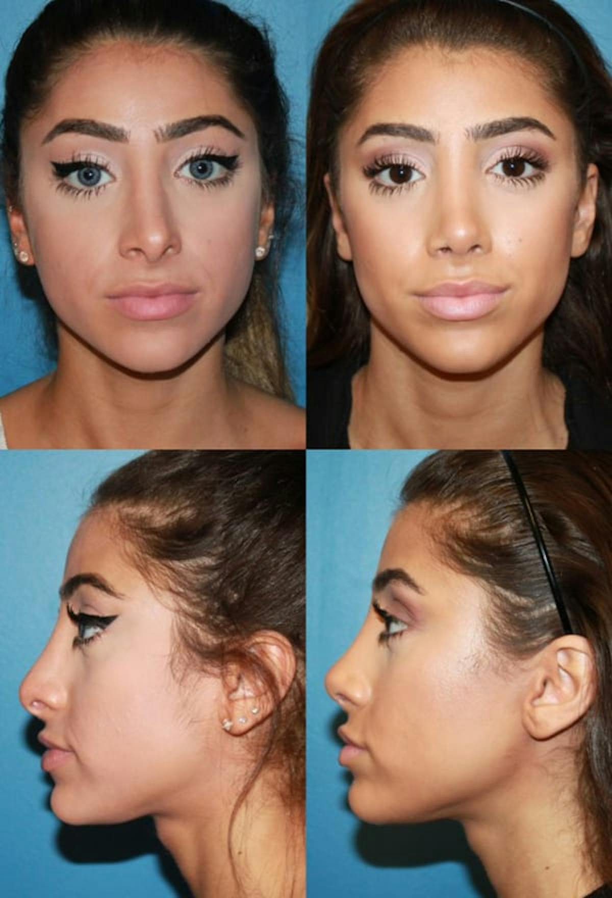 Female Revision Rhinoplasty Before & After Gallery - Patient 110138 - Image 1