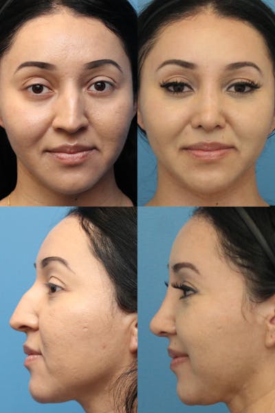 Crooked Nose Before & After Gallery - Patient NgUTbY7fSduvaIHACLMg9g - Image 1