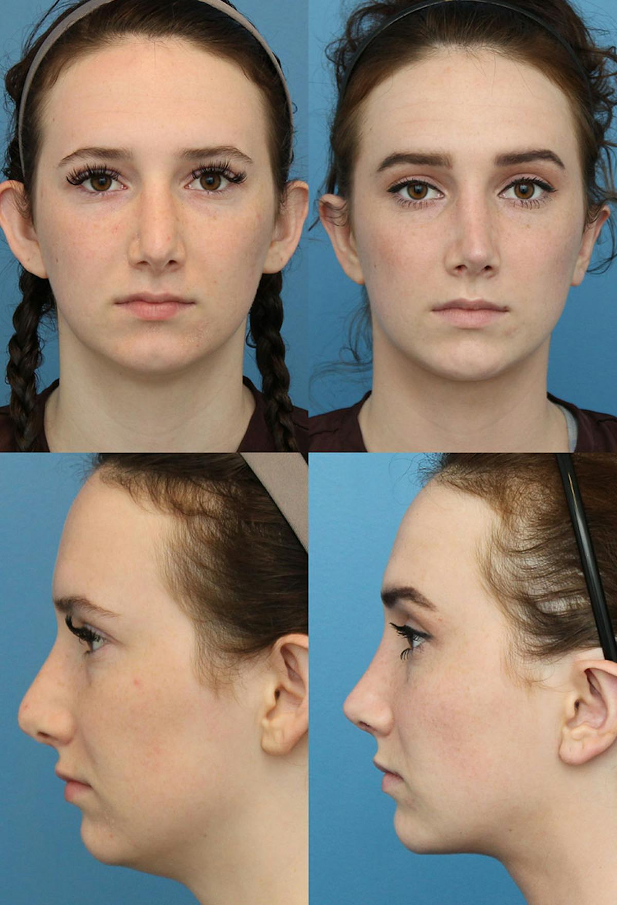 Female Revision Rhinoplasty Before & After Gallery - Patient 140297 - Image 1