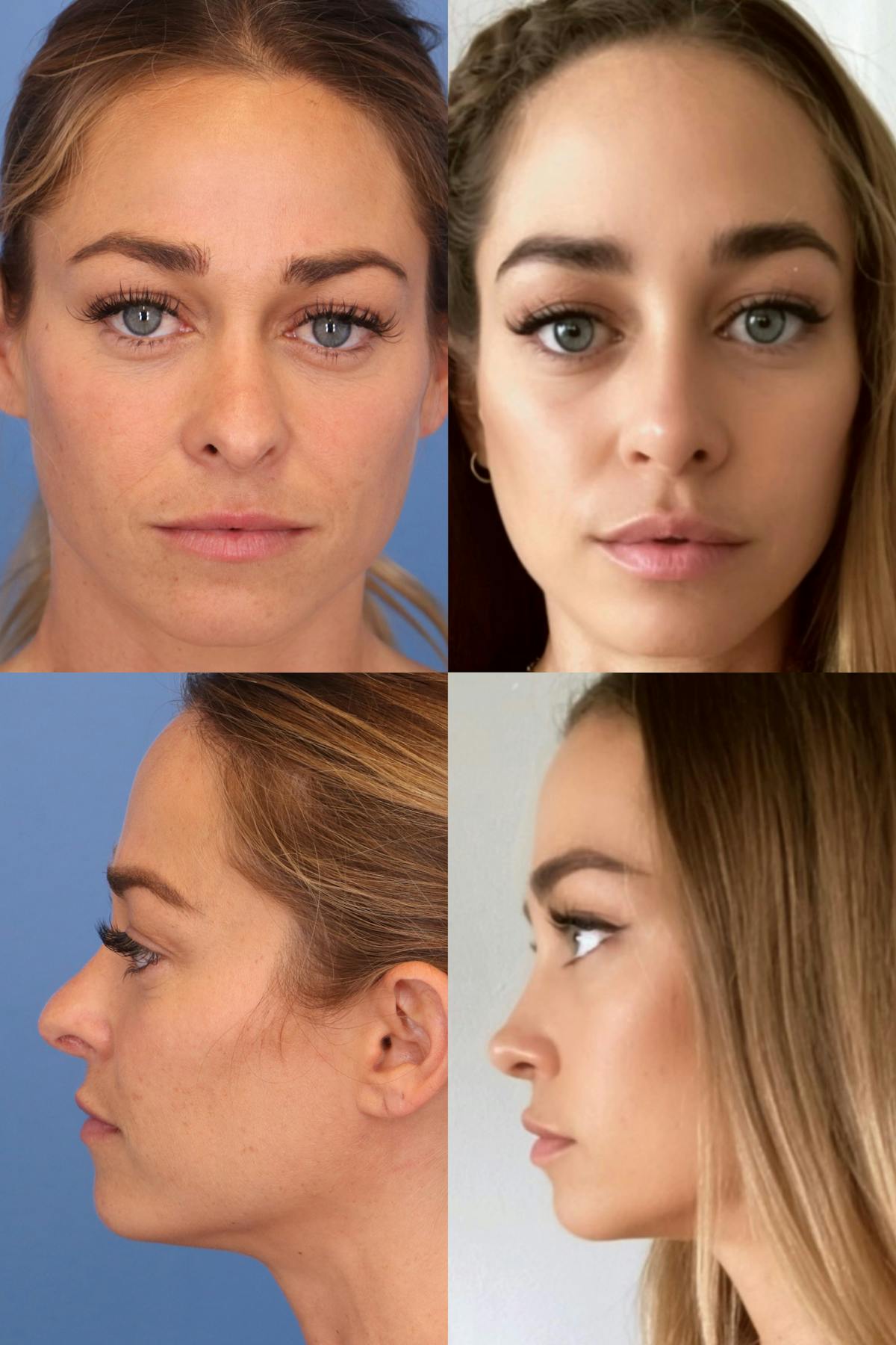 Female Revision Rhinoplasty Before & After Gallery - Patient 185611 - Image 1