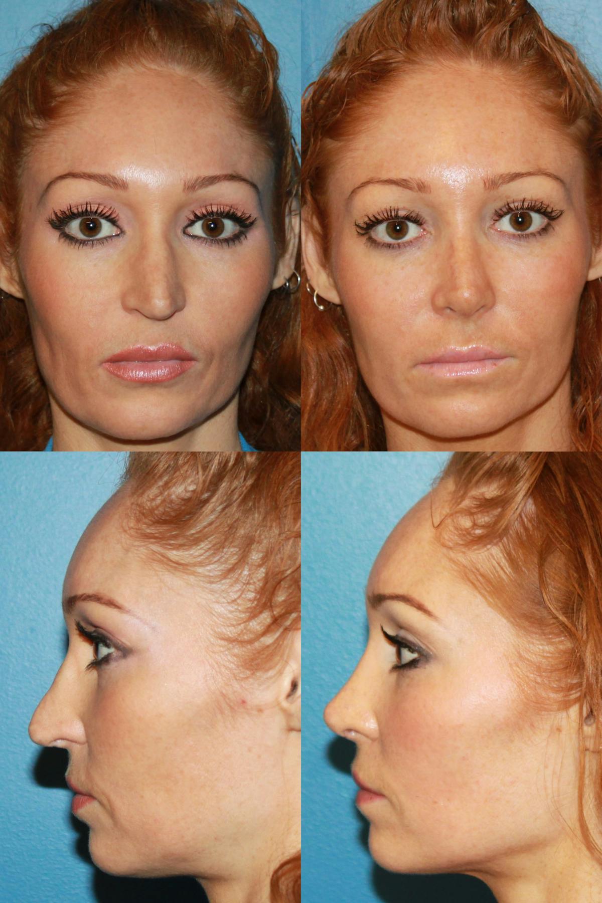 Female Revision Rhinoplasty Before & After Gallery - Patient 368184 - Image 1