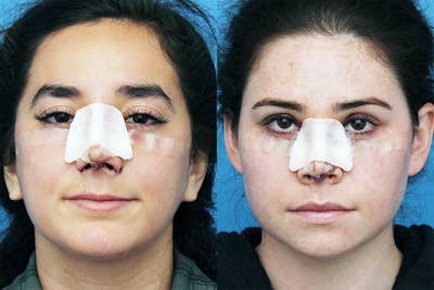 No bruise Rhinoplasty – One day Post-operative Before & After Gallery - Patient EgXBgKJkRWGlAaWI05gX9A - Image 1