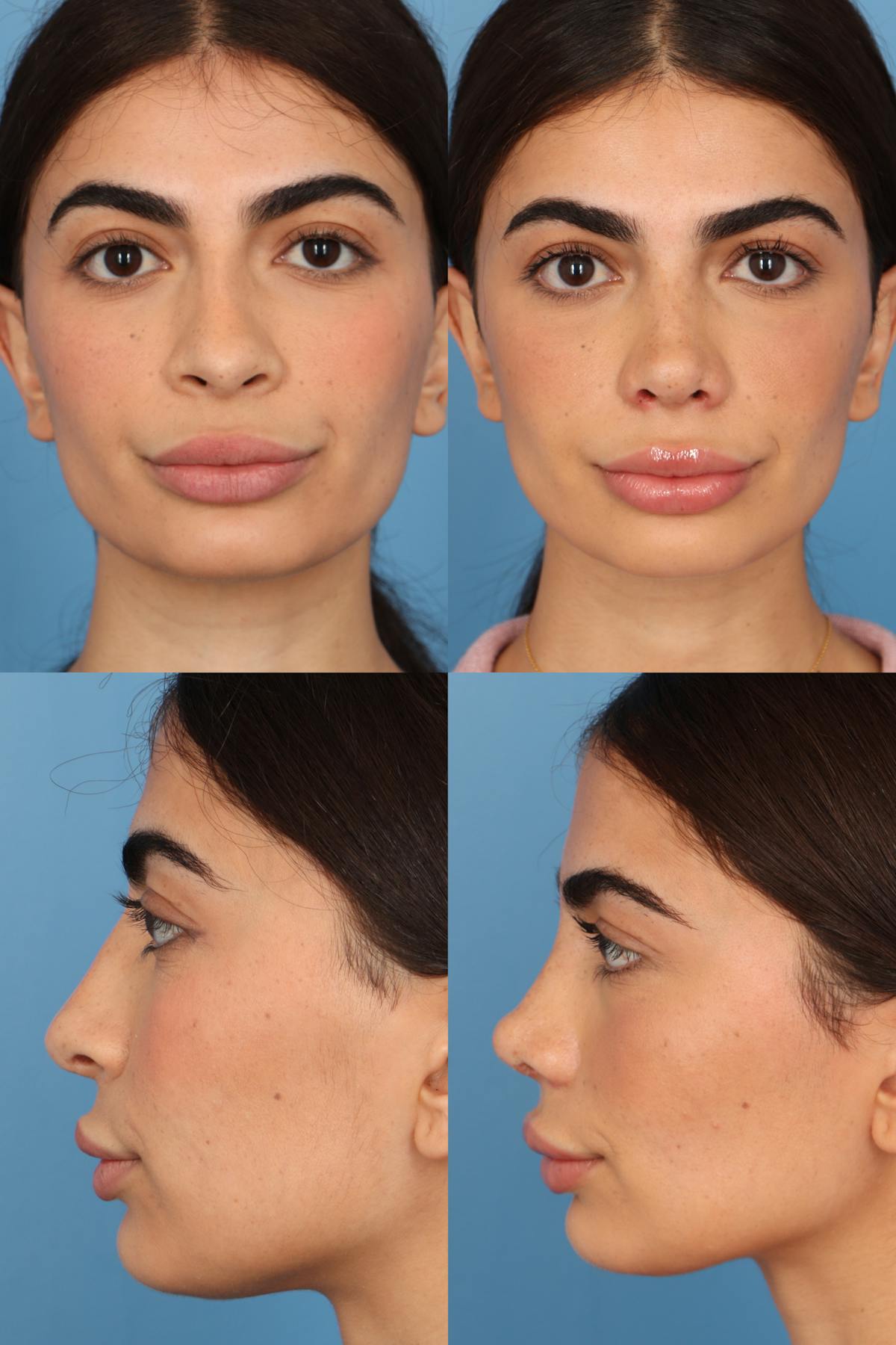 Female Revision Rhinoplasty Before & After Gallery - Patient 357323 - Image 1