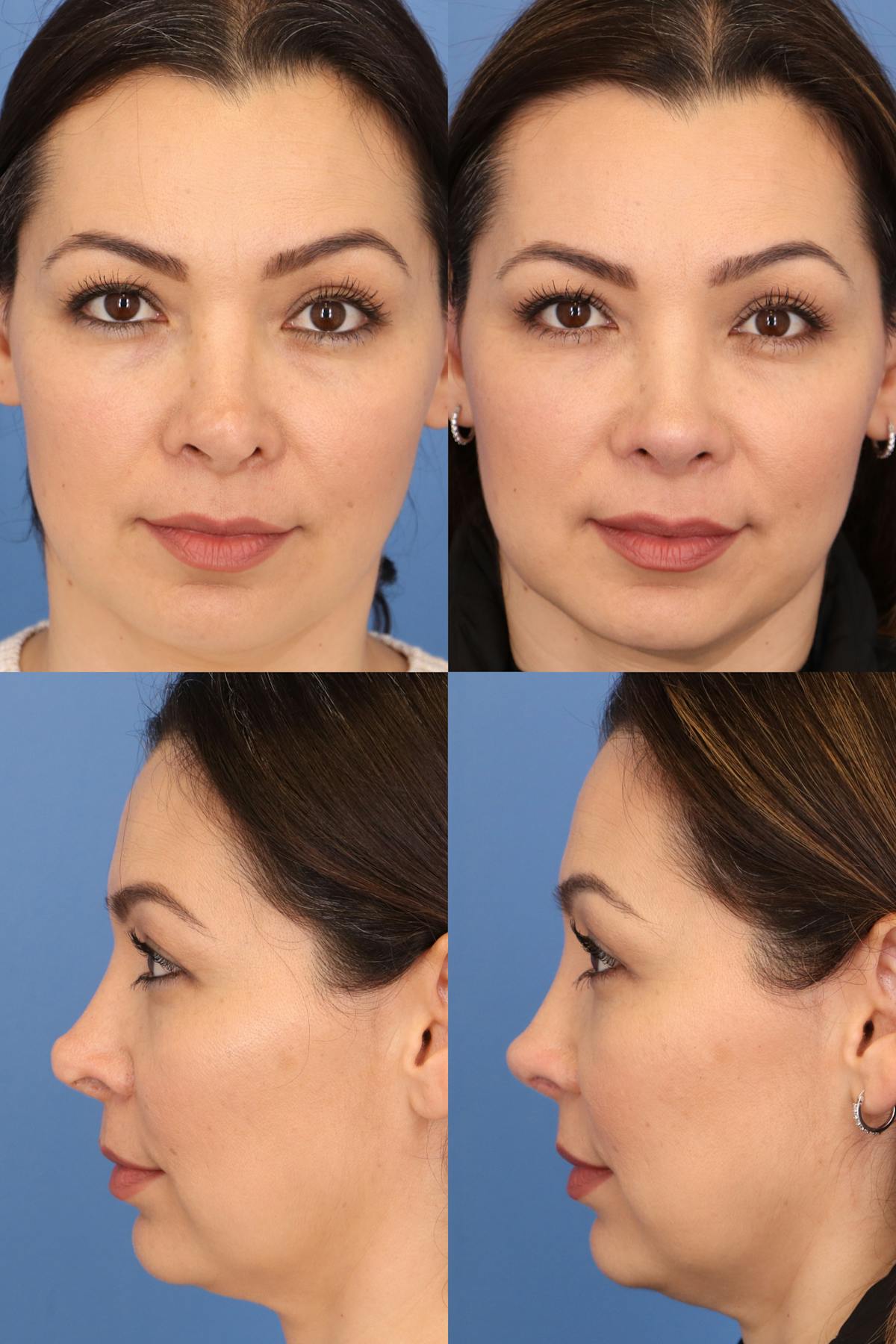 Female Revision Rhinoplasty Before & After Gallery - Patient 168651 - Image 1