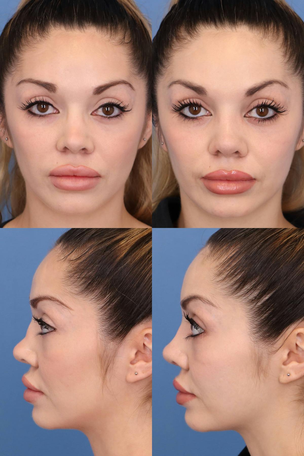 Female Revision Rhinoplasty Before & After Gallery - Patient 355188 - Image 1