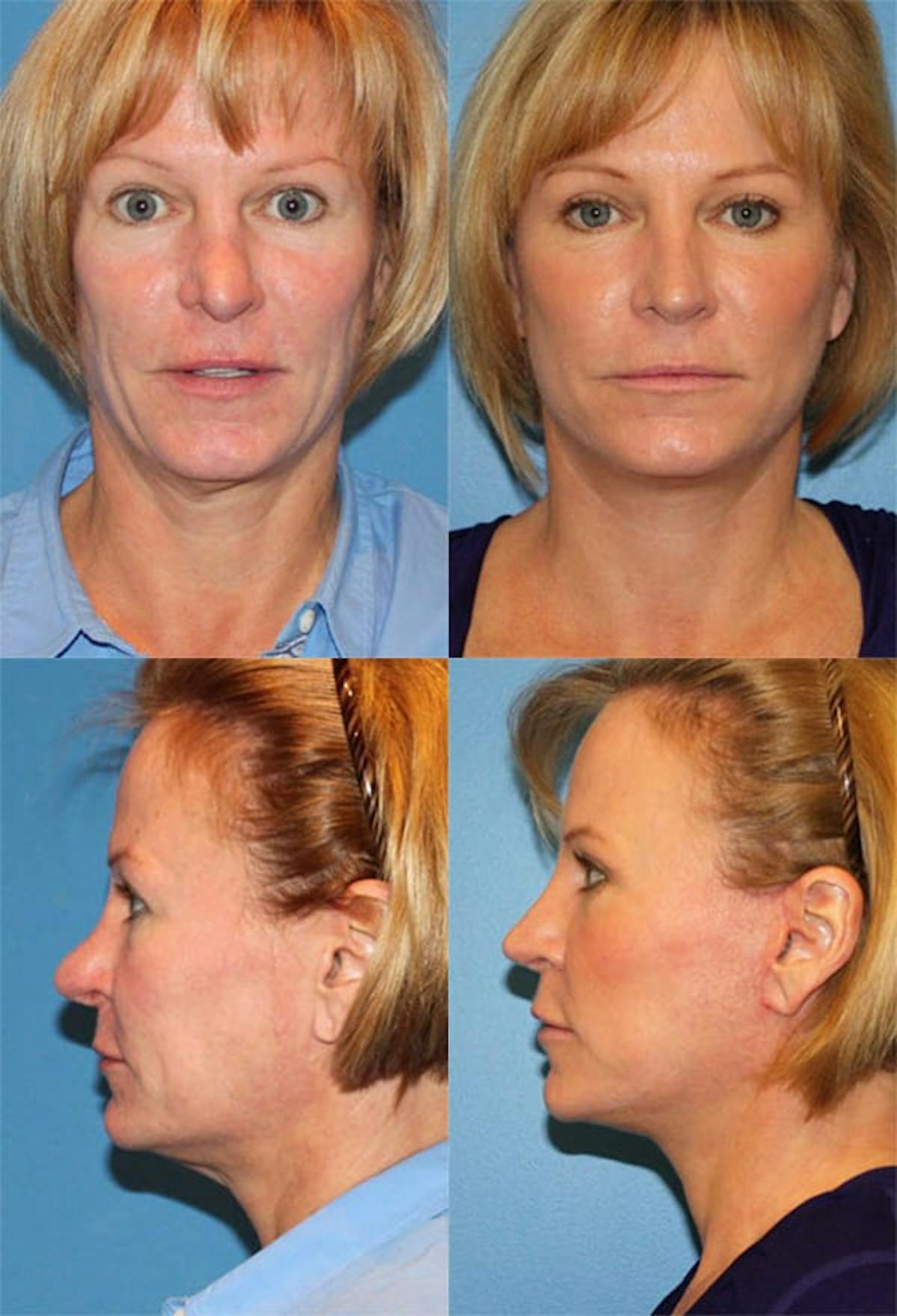 Female Revision Rhinoplasty Before & After Gallery - Patient 165841 - Image 1
