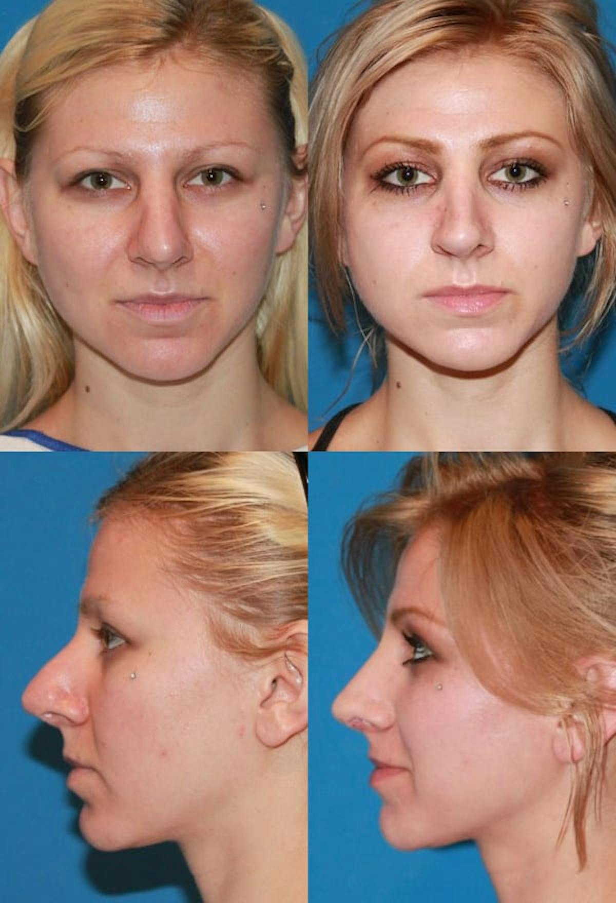Female Revision Rhinoplasty Before & After Gallery - Patient 265848 - Image 1
