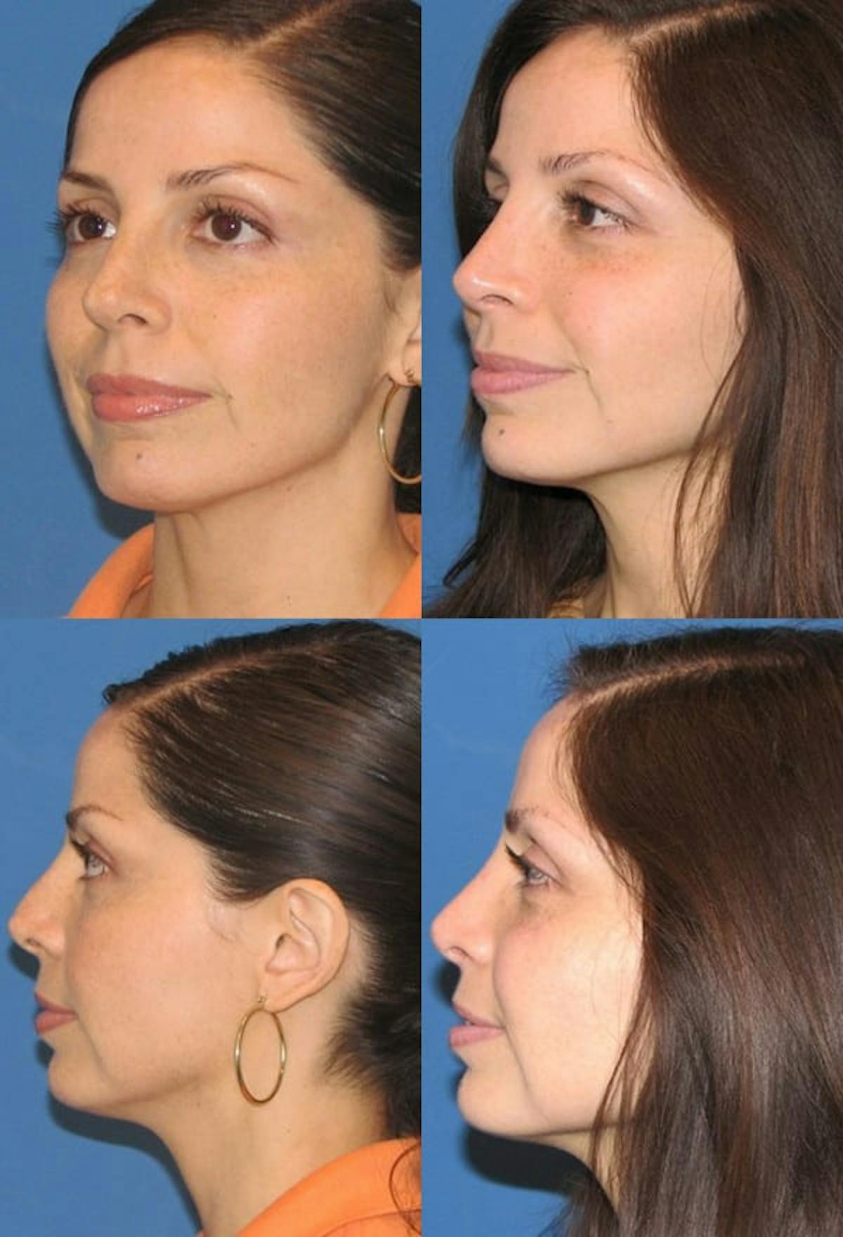 Female Revision Rhinoplasty Before & After Gallery - Patient 289445 - Image 1