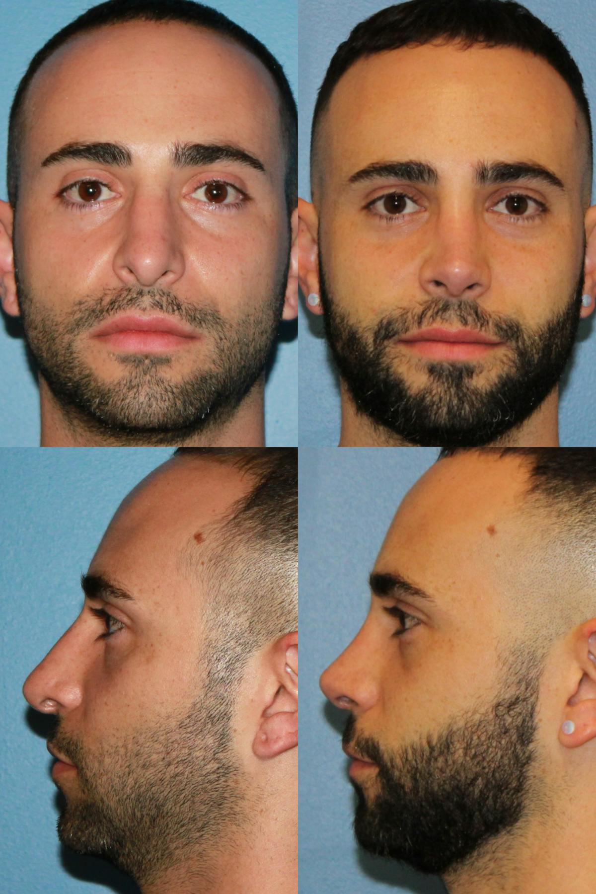 Male Revision Rhinoplasty Before & After Gallery - Patient 220335 - Image 1