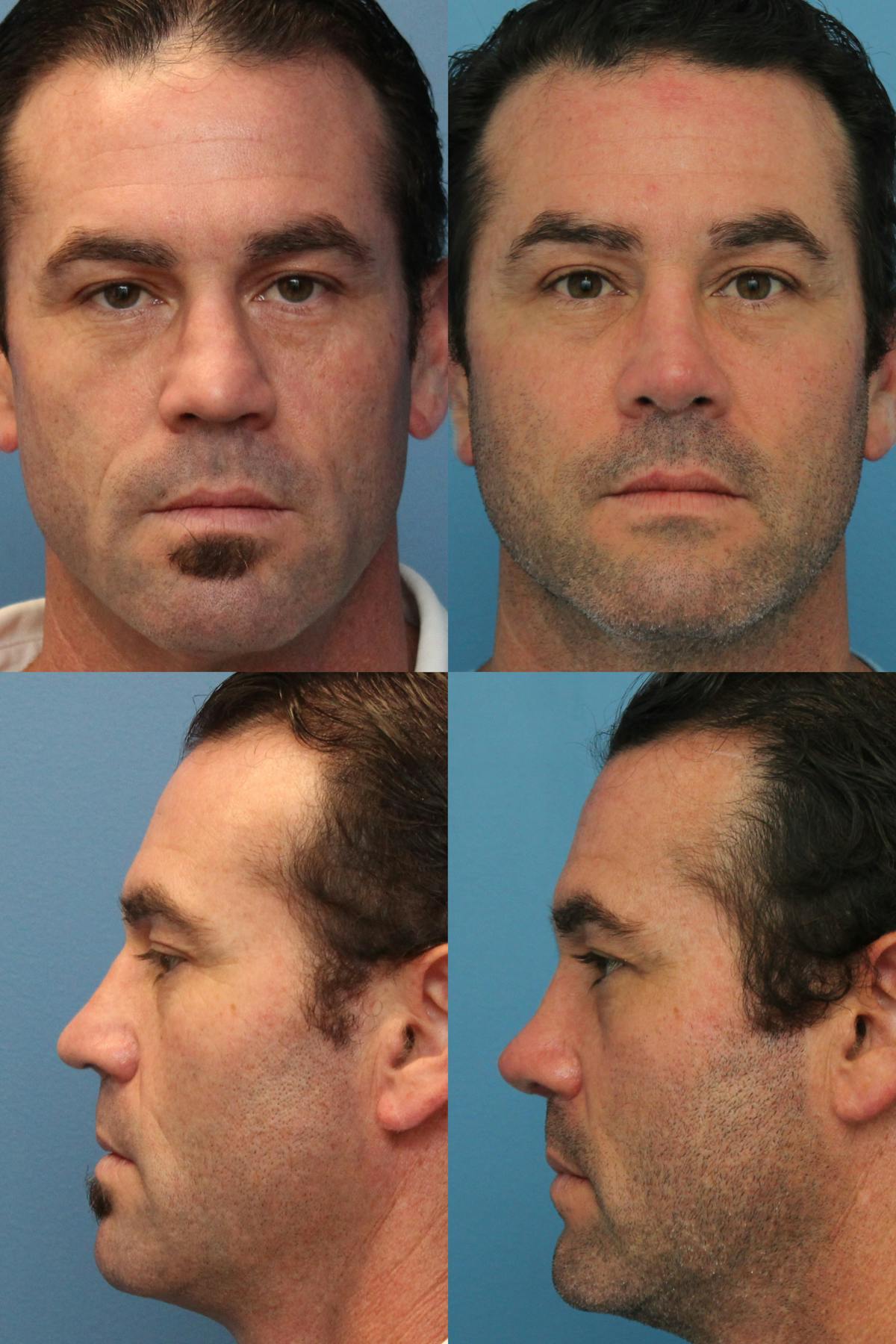 Male Revision Rhinoplasty Before & After Gallery - Patient 716364 - Image 1