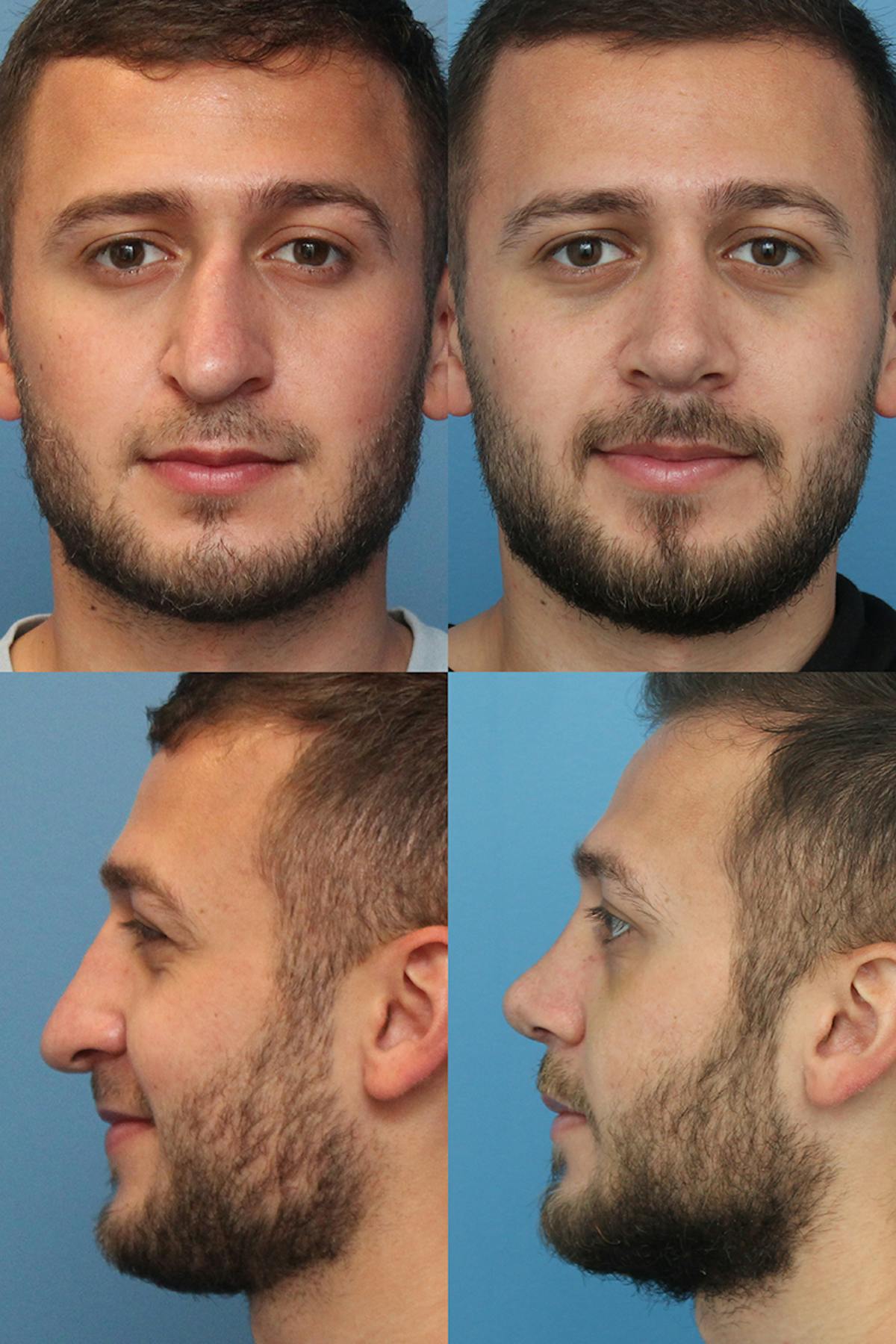 Male Revision Rhinoplasty Before & After Gallery - Patient 396183 - Image 1