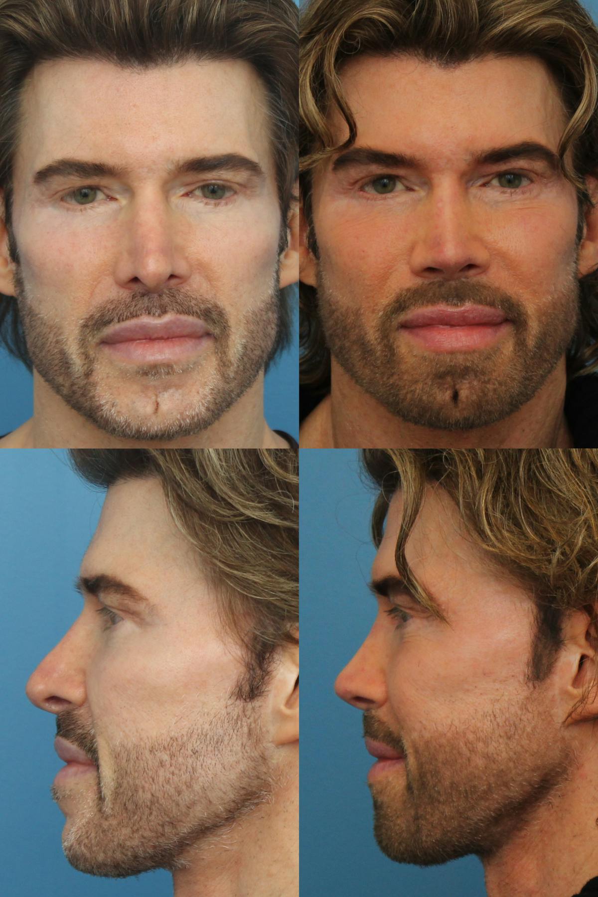 Male Revision Rhinoplasty Before & After Gallery - Patient 112103 - Image 1