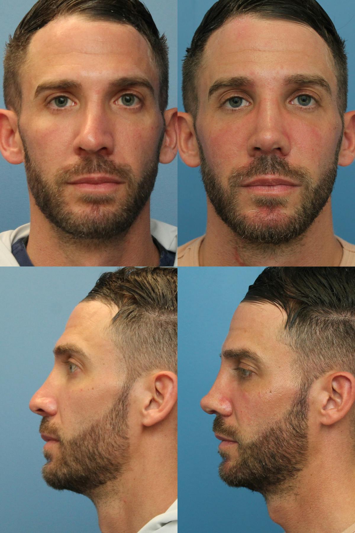 Male Revision Rhinoplasty Before & After Gallery - Patient 130837 - Image 1