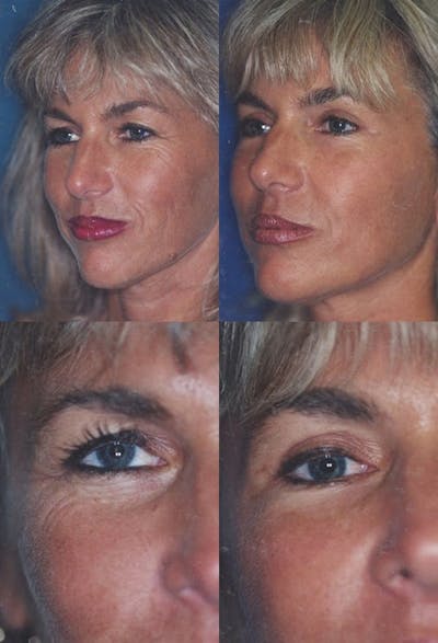 Upper Blepharoplasty Before & After Gallery - Patient 636117 - Image 1