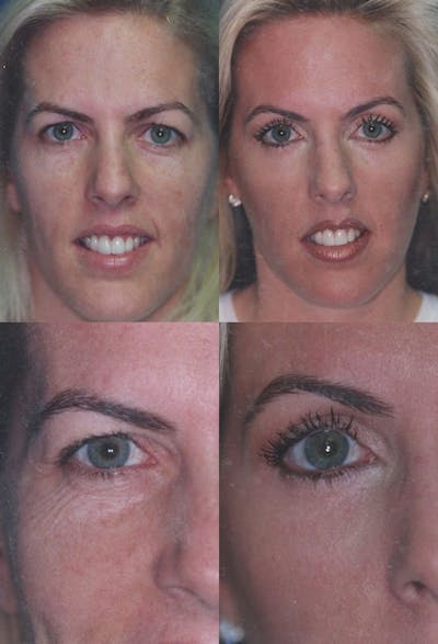 Upper Blepharoplasty Before & After Gallery - Patient 261299 - Image 1