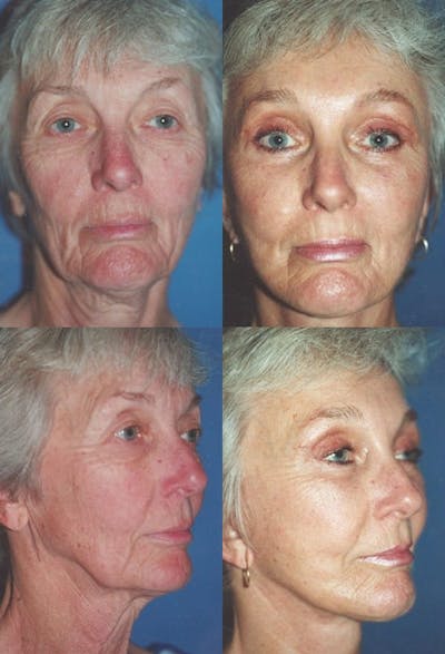 Upper Blepharoplasty Before & After Gallery - Patient 178162 - Image 1