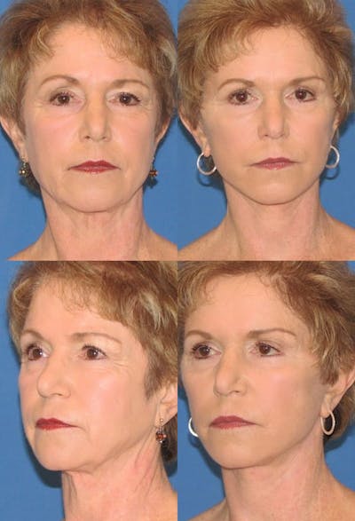 Upper Blepharoplasty Before & After Gallery - Patient 234858 - Image 1