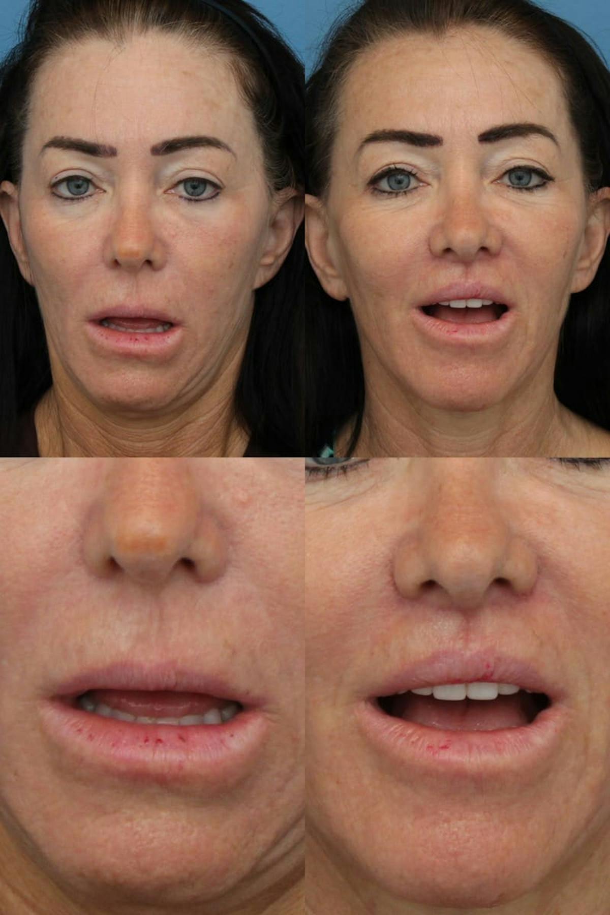 Lip Lift Before & After Gallery - Patient 964638 - Image 1