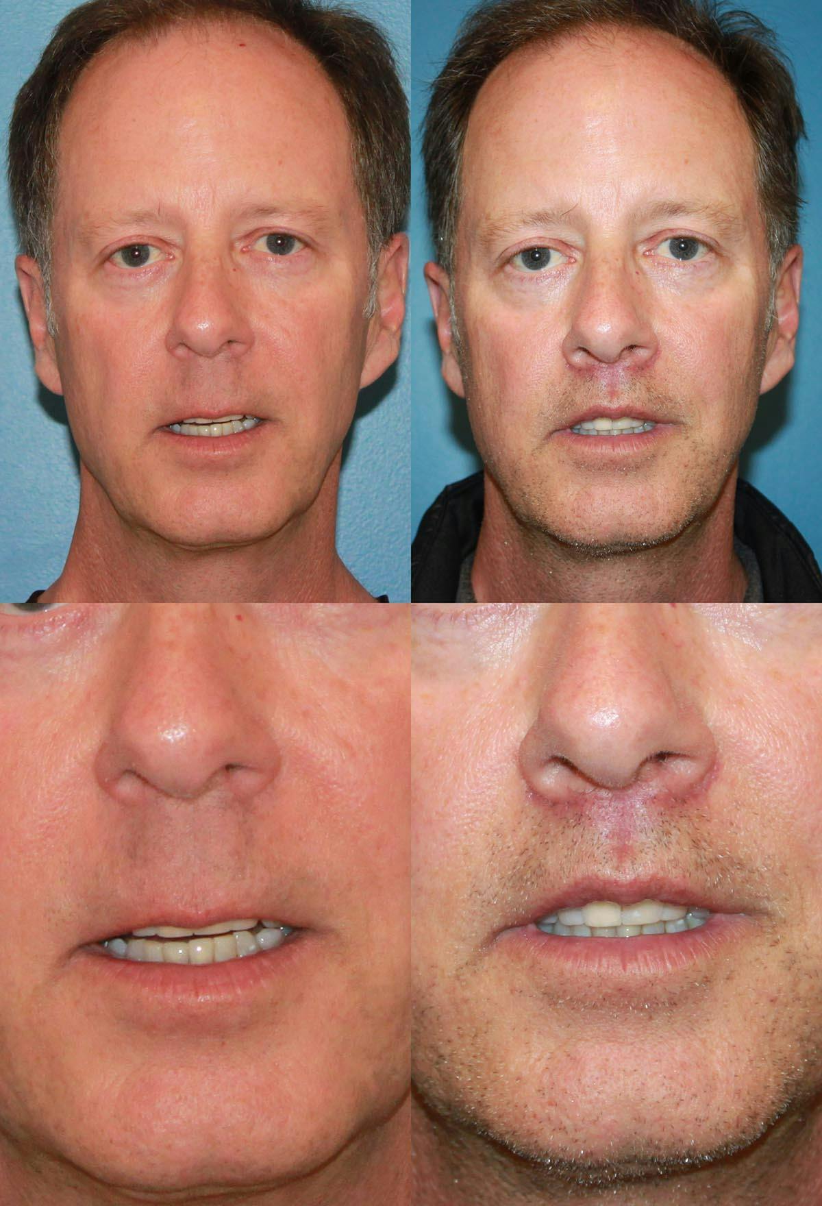 Lip Lift Before & After Gallery - Patient 133161 - Image 1