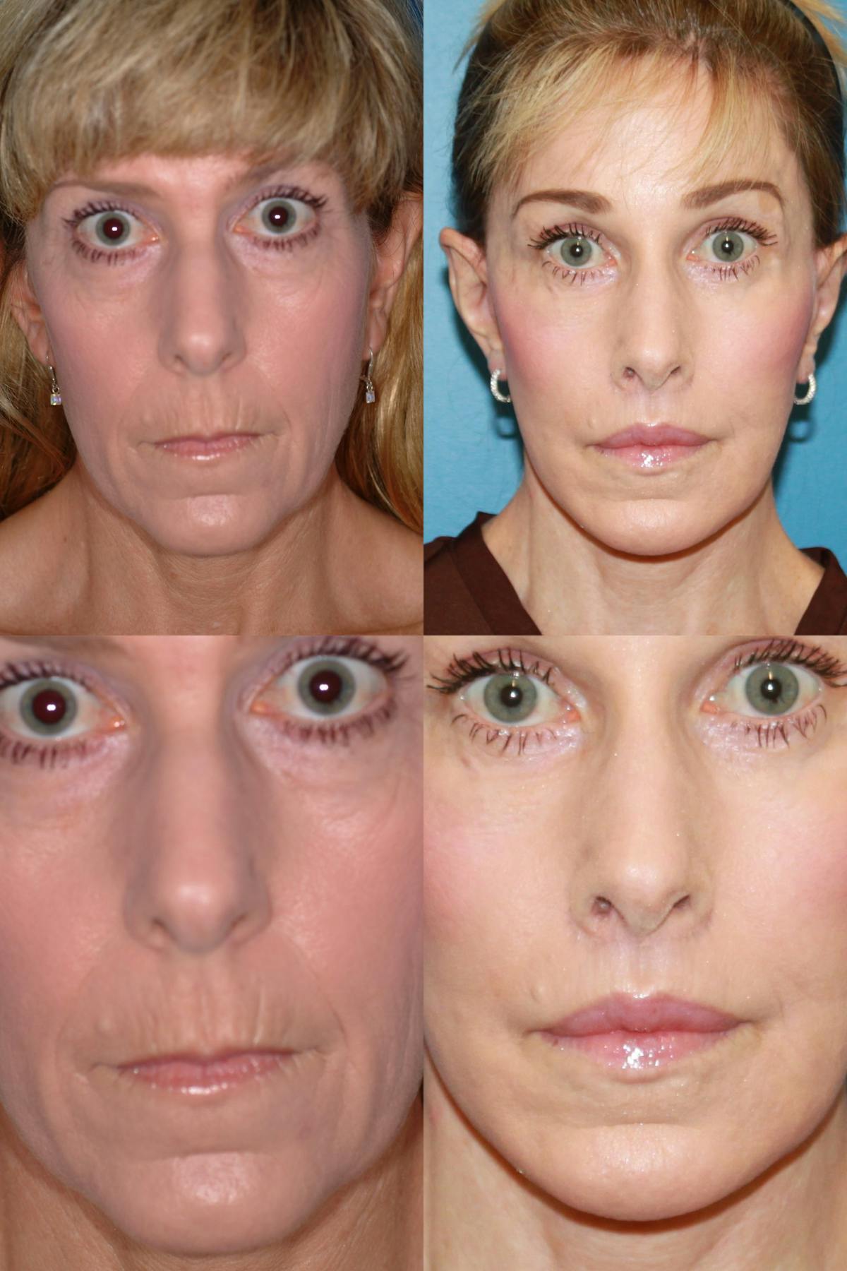 Lip Lift Before & After Gallery - Patient 100010 - Image 1