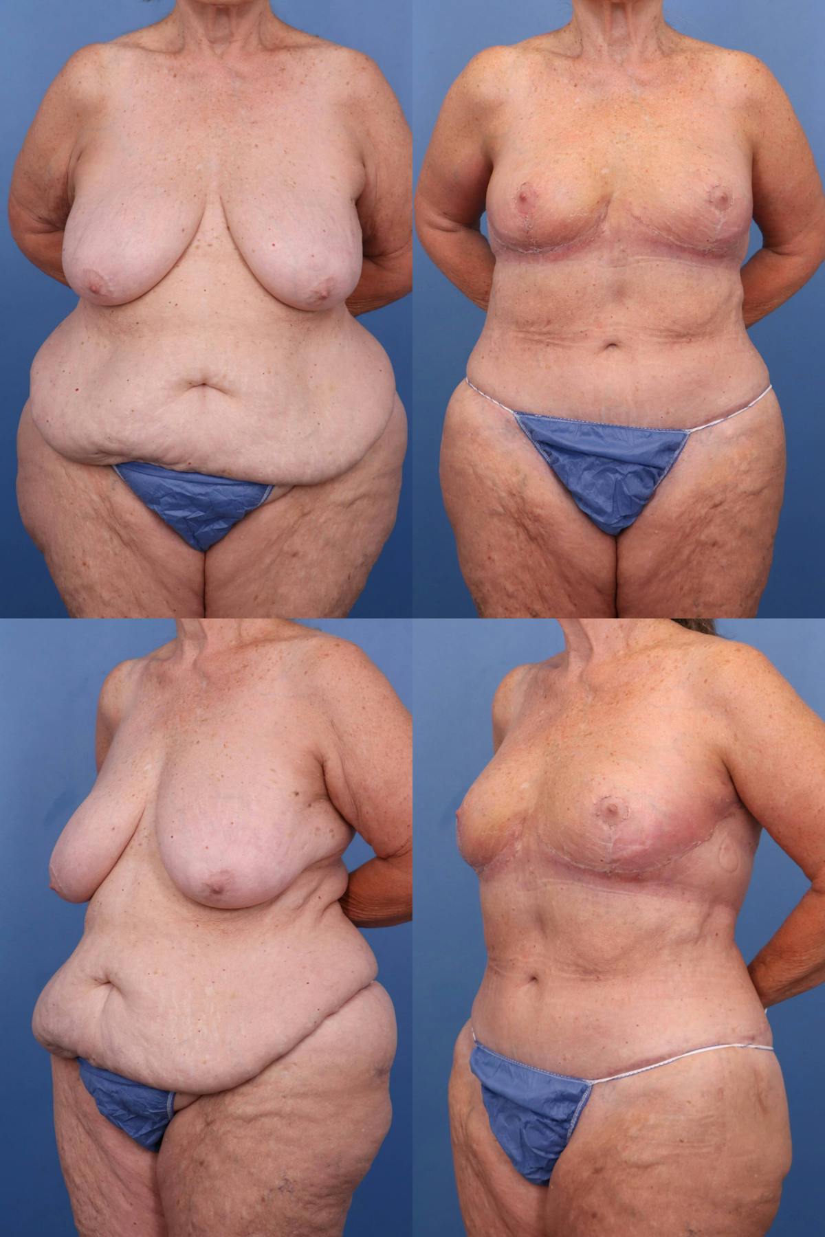 Mommy Makeover Before & After Gallery - Patient 278481 - Image 1