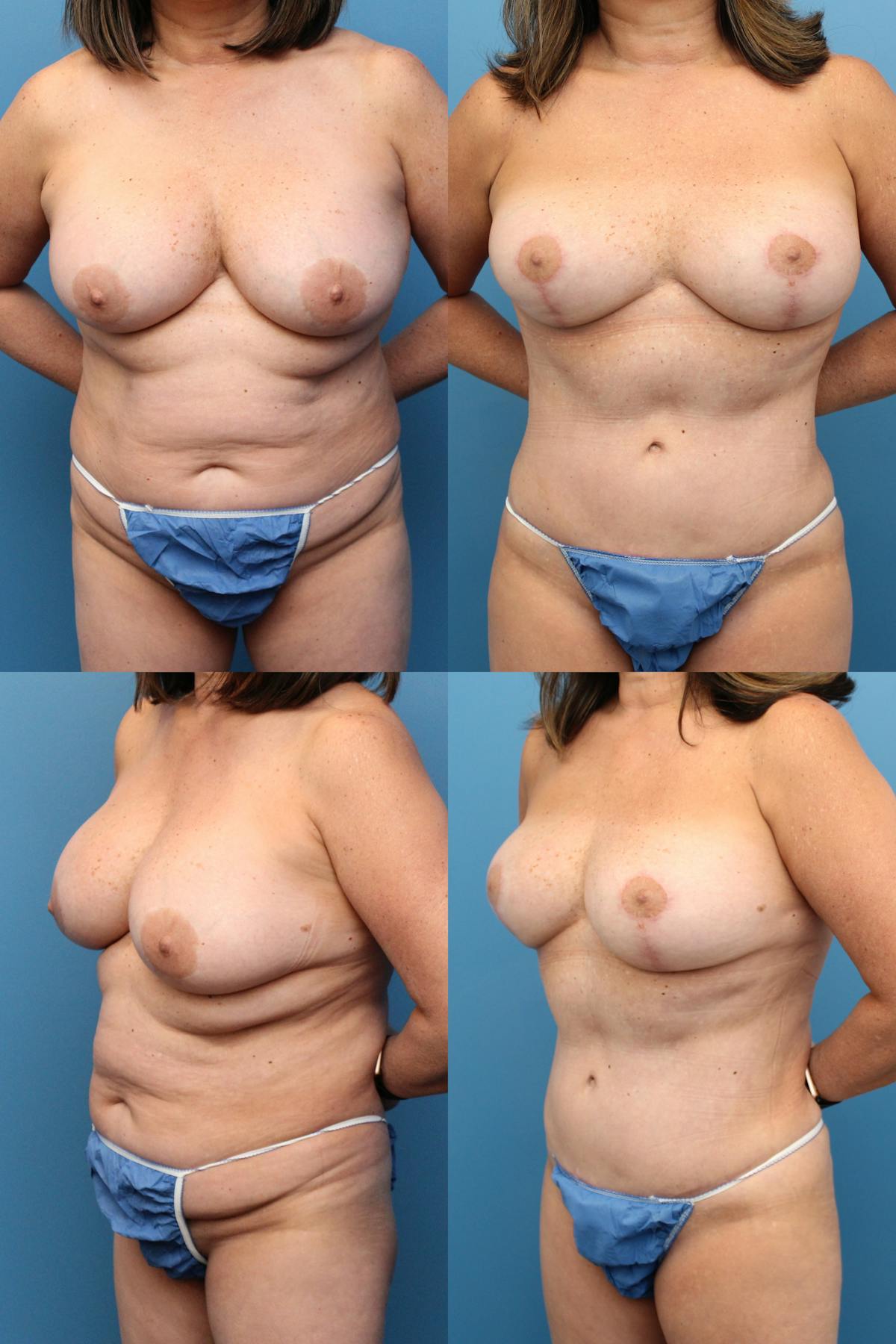 Mommy Makeover Before & After Gallery - Patient 943735 - Image 1