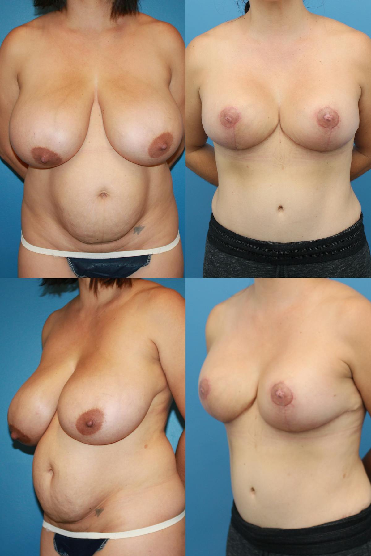 Mommy Makeover Before & After Gallery - Patient 354141 - Image 1