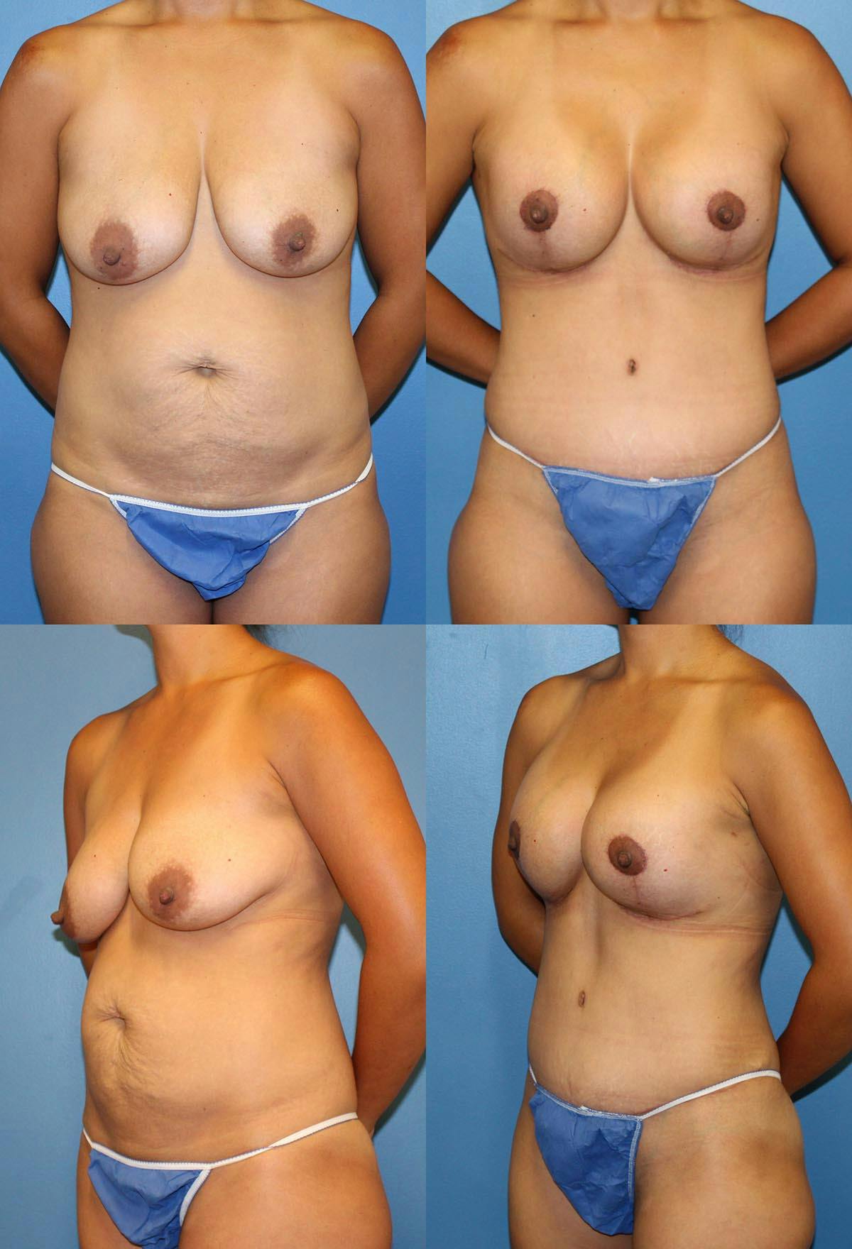 Mommy Makeover Before & After Gallery - Patient 288604 - Image 1