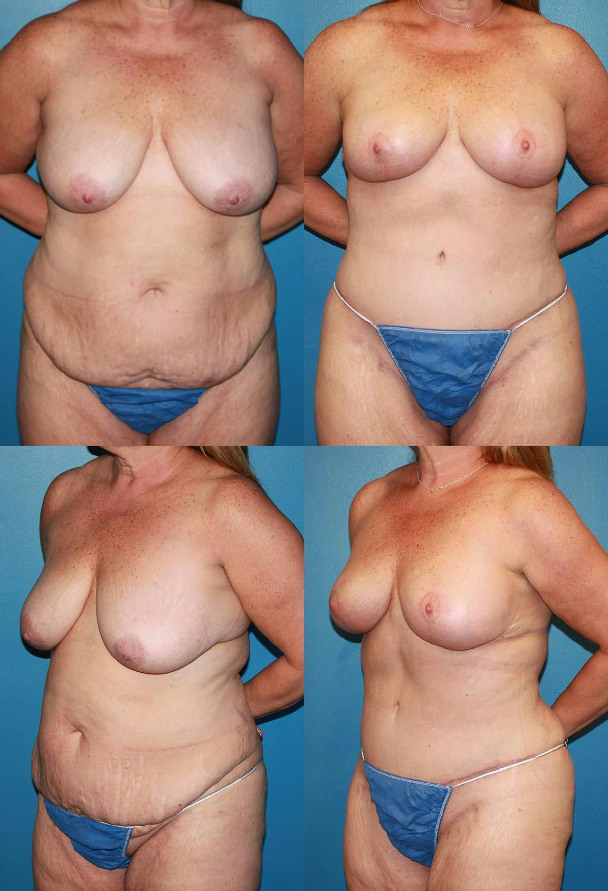 Mommy Makeover Before & After Gallery - Patient 482437 - Image 1