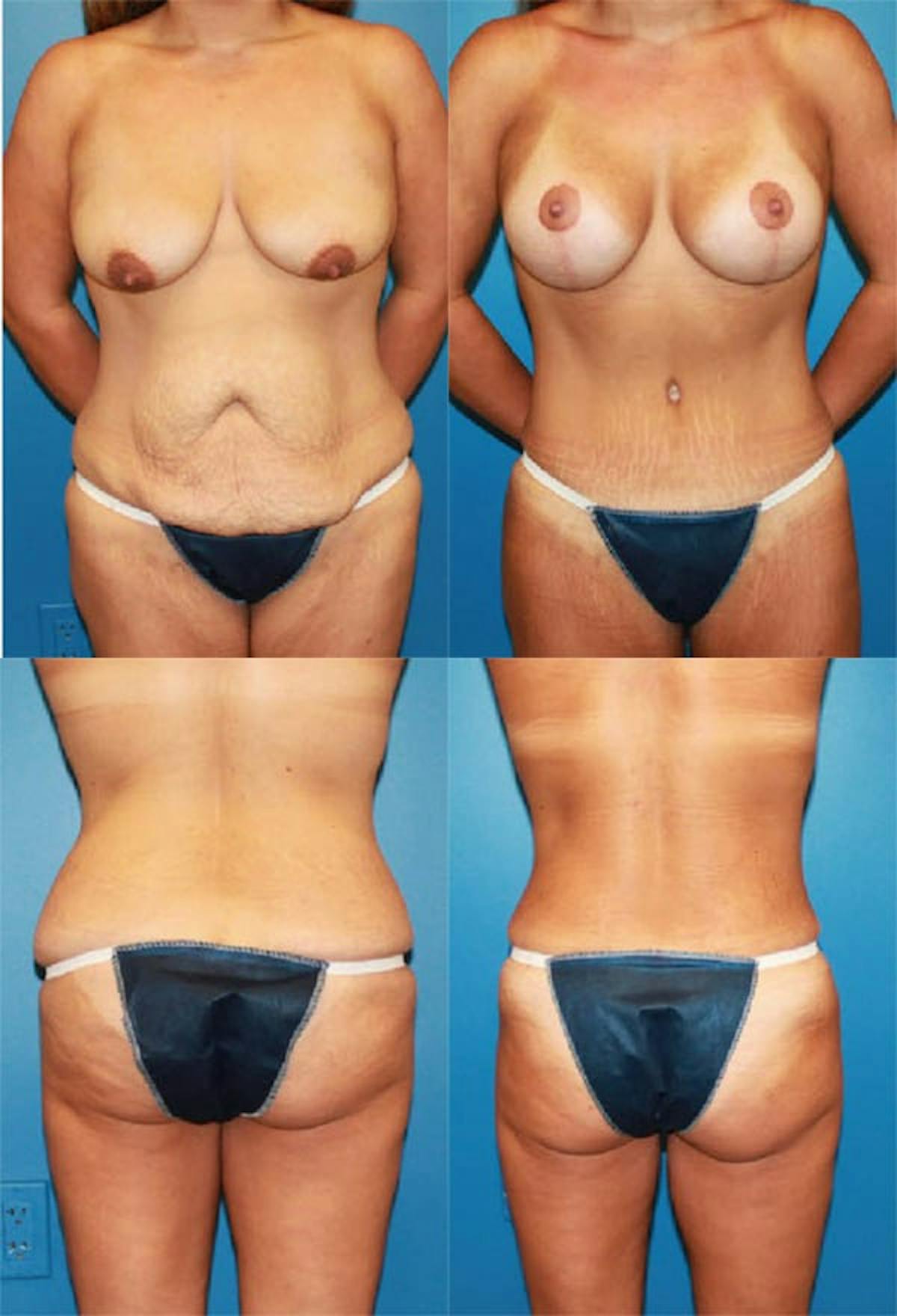 Mommy Makeover Before & After Gallery - Patient 176910 - Image 1