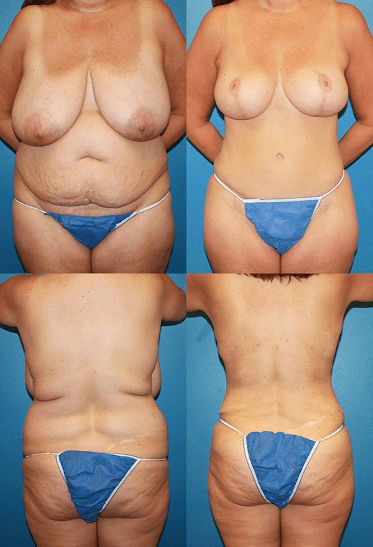 Tummy Tuck Before & After Gallery - Patient 291156 - Image 1