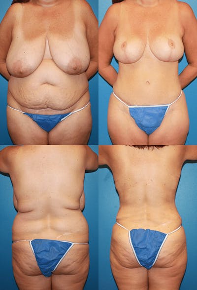 Tummy Tuck Before & After Gallery - Patient 291156 - Image 1