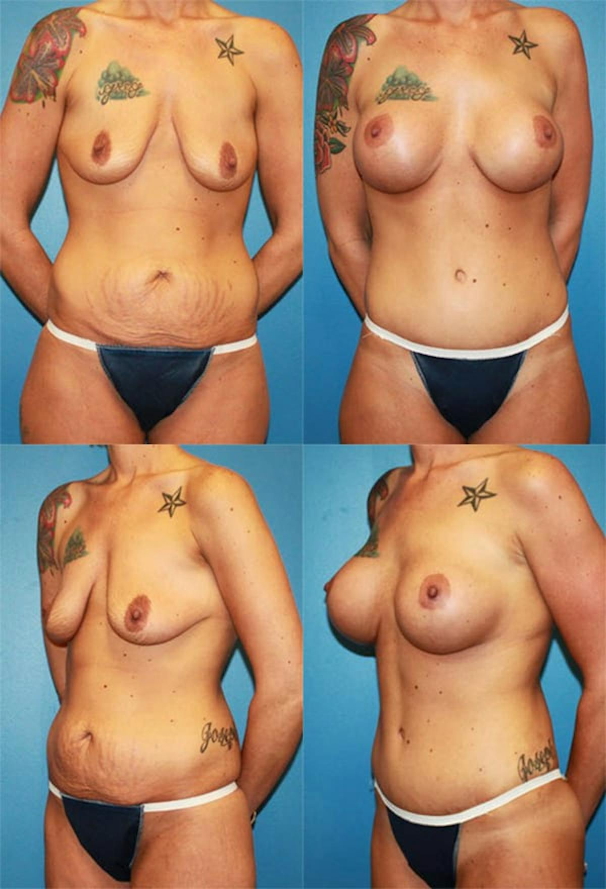 Mommy Makeover Before & After Gallery - Patient 421259 - Image 1